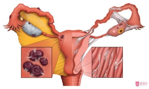 子宮內(nèi)膜異位癥g (2).jpg